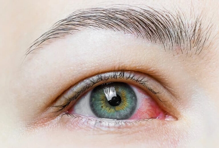 Чи буває алергія на контактні лінзи?