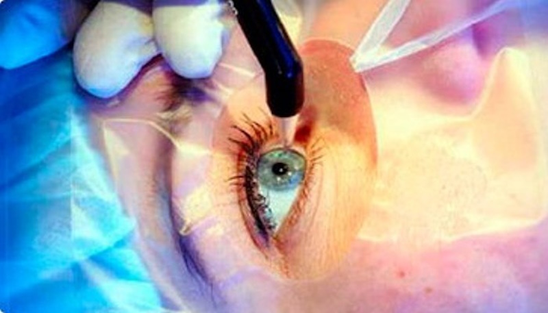 Лікування глаукоми 2.0: за межами трабекулектомії